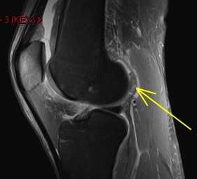 Figure 5 for case Osteochondral fracture femur with displaced fragment